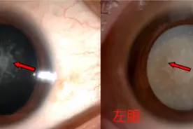 不当使用眼部按摩仪，他患上白内障！青岛眼科医院提醒：小心神器变凶器图片