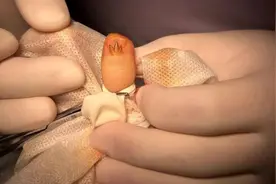 女子频繁美甲，指甲上现“三叉戟” 医生：赶紧切图片