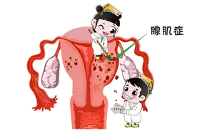 痛经持续加重？济南青华医院医生：小心子宫腺肌症在作怪！图片