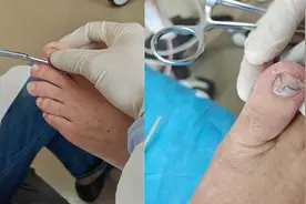 给趾甲矫形，解决患者甲沟炎困扰图片