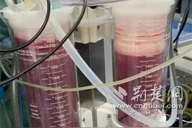 患者肝肿瘤破裂大出血 多学科抢救“拼出”救命时间图片