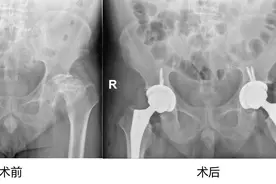 49岁男子股骨头坏死，原因竟与这个不良生活习惯有关！图片