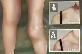 【朝医科普】早筛查早诊断让硬皮病患者的就医之路不再曲折图片