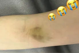 小小针眼学问大，你按压对了吗？丨贤医健康说图片