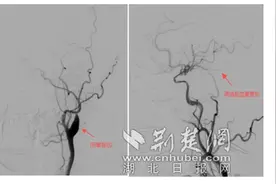 男子突然失明“真凶”竟是颈内动脉闭塞 医生火速开通血管终“抢”回光明图片