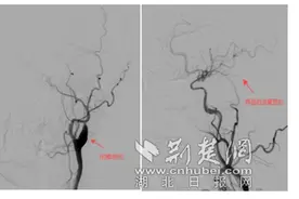 男子突然失明“真凶”竟是颈内动脉闭塞 医生火速开通血管终“抢”回光明图片