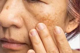 春天是祛斑“黄金季节”，但“反黑”到底是做错了什么？图片