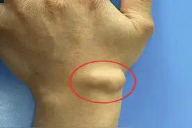 永医科普丨长了腱鞘囊肿怎么办？图片