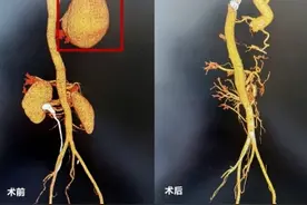 厦门一小伙心脏边“长”出12厘米的“瘤子”图片