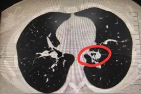 假期高发！警惕这个“餐桌刺客”图片