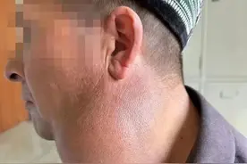 【“人民”纪实】新疆大叔千里寻医记，“怪病”在这里治愈图片