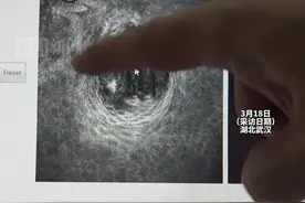 8岁男童眼睛发红干痒还畏光，检查发现一根睫毛上有8条螨虫，医生：或是与宠物接触后直接揉眼所致图片