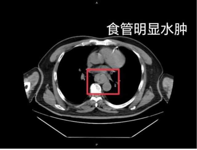 仅误吞一口，2岁男童住进PICU！很多人爱这样吃
