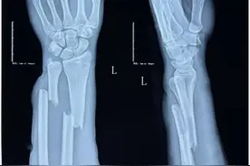 高三体育生严重骨折，离体考不到100天……中医正骨，15秒复位图片