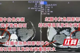 结石梗阻引发双肾积水 女子自行吃草药排石数月险酿大祸图片