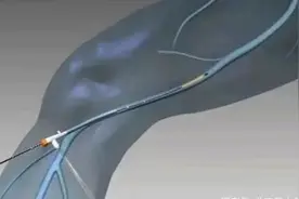 下肢静脉曲张高发于这些人群！医生建议：不要跷二郎腿或泡脚图片