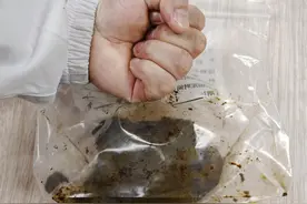 八旬老人体内取出386克“石头” 创单个桥袢结石世界纪录图片