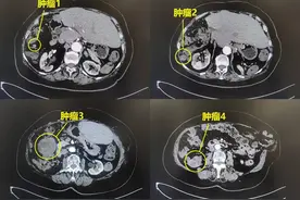 7旬老人与肿瘤斗争30年，微创手术切除多发病灶图片