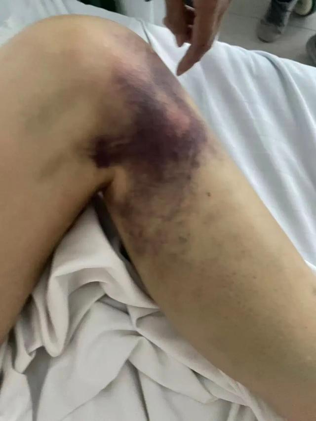 陕西一医院施工不合格	，监理白天要求拆除整改，当晚被打断4根肋骨，“工区突然断电，被3人打晕	”	，警方刑事立案