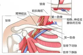 女子手臂麻木肩颈疼痛并不是颈椎病，而是身体里的“交通堵塞”图片
