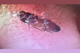 印度一医院称在患者小肠中发现3厘米长活蟑螂，幸被及时取出视频封面