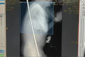 男子高坠，1.3米长钢筋贯穿整个胸腹腔，医院展开7小时生死大援救图片
