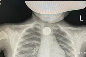 8岁男孩误吞硬币，医生5分钟微创取出图片