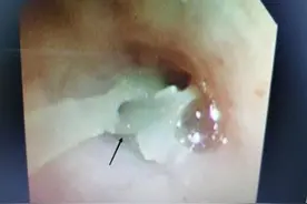 1岁宝宝咳喘久久不愈 竟是4根鱼骨藏在气管7个月图片
