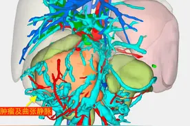 癌肿根治切除联合自体小肠移植再造 罕见病患儿重获新生图片