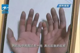 以为是冻疮，却是“红斑狼疮”，严重时危及生命！它专盯年轻女性图片