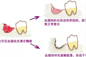 女子嘴里发出粪便般腐臭！只因做了……紧急提醒：24小时内抓紧就医图片