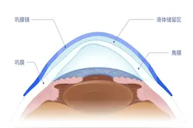 周浦医院成功验配浦东首枚国产巩膜镜图片