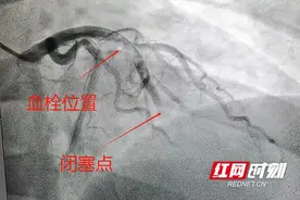 益阳：长期“熬夜+抽烟”，90后小伙突发心梗险丧命图片
