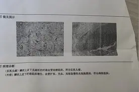 长达10厘米！肛周长出的“小尾巴”，竟不是痔疮是肛乳头瘤图片
