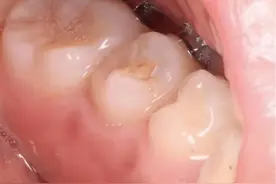 “静”享健康丨牙齿上长“犄角”？竟然是……图片