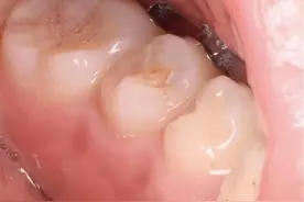 “静”享健康丨牙齿上长“犄角”？竟然是……图片