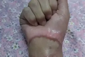 34岁女子终于又能“握紧拳头”了图片