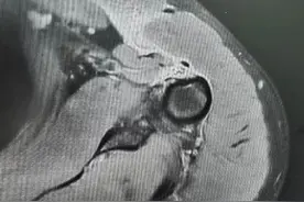 健身惨遭意外 胸大肌瞬间撕裂！图片