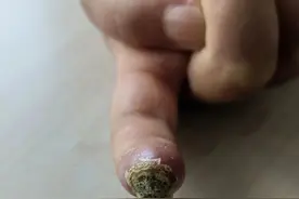 红斑狼疮患者磨破指尖拖成骨髓炎，患有基础病小伤口别掉以轻心图片