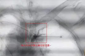 老人胸前长痘误以为被小虫叮咬没在意，怎料竟是带状疱疹找上门图片