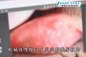 小伙眼睛长出“鹅卵石”？医生提醒：春季多发图片