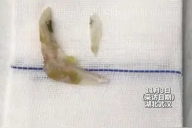 鱼骨卡喉后男子吞饭“硬”咽，不料小小鱼骨竟扎穿食道图片