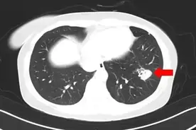 肺部“发霉”，高烧40℃！“元凶”竟藏在家中？图片