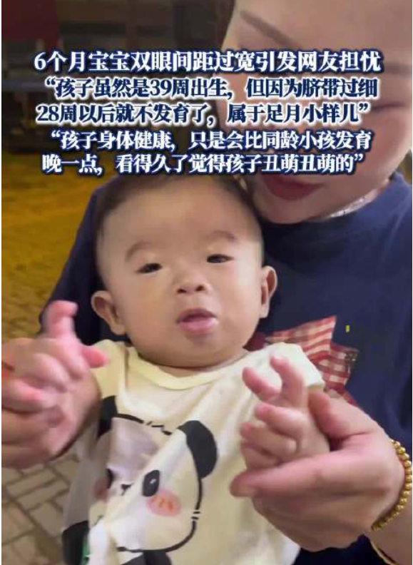 宝妈回应6个月宝宝双眼间距过宽
