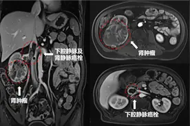 医路前行|中国医科大学附属第一医院泌尿外科、心脏外科等多学科联合 顺利完成高难度肾癌根治切除及下腔静脉癌栓取栓术图片