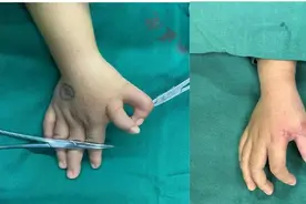 2岁幼儿手指似“蟹钳”，显微外科“移花接木”巧矫正图片