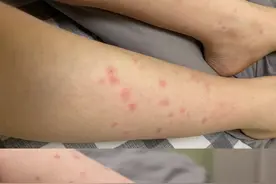 没有蚊子咬却出现“蚊子包”，医生：谨防虫咬皮炎，症状相似攻击力更强，需及时干预图片
