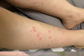 没有蚊子咬却出现“蚊子包”，医生：谨防虫咬皮炎，症状相似攻击力更强，需及时干预图片