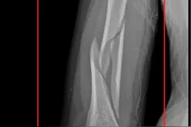 男子聚餐后与朋友“掰腕子”一决高低，用力过猛致上臂骨折图片