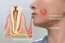 “痘痘”“皮肤感染”总不好？根源竟是牙齿问题！快自查→图片